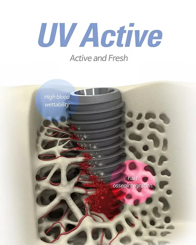 Ankara UV İmplant Tekniği ile Dikişsiz İmplant Kliniği